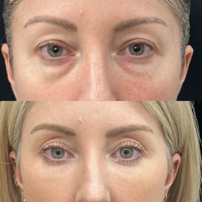 Lower Blepharoplasty Before & After Gallery - Patient 312834 - Image 2
