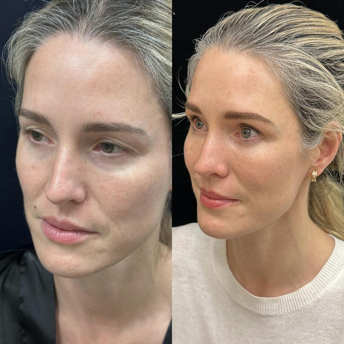 Lower Blepharoplasty Before & After Gallery - Patient 235608 - Image 4