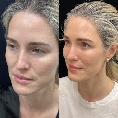 Lower Blepharoplasty Before & After Gallery - Patient 235608 - Image 4