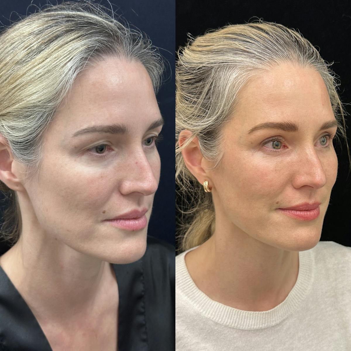 Lower Blepharoplasty Before & After Gallery - Patient 235608 - Image 3