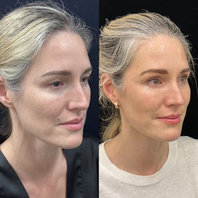 Lower Blepharoplasty Before & After Gallery - Patient 235608 - Image 3