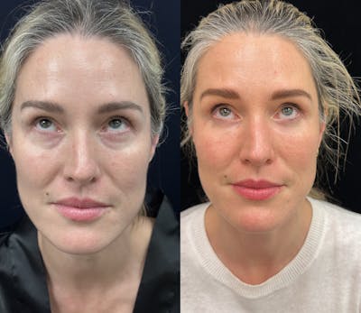 Lower Blepharoplasty Before & After Gallery - Patient 235608 - Image 2