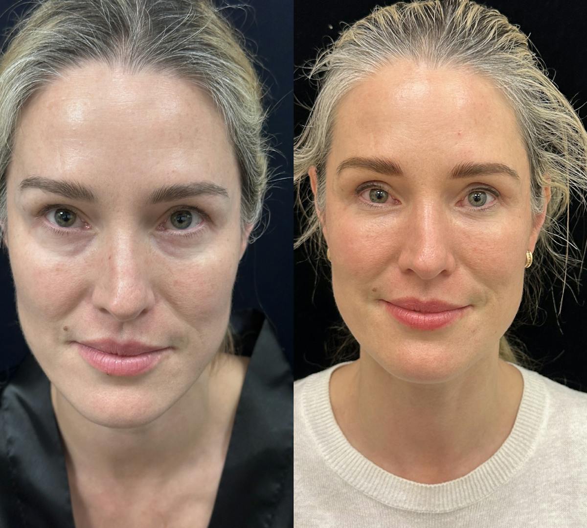 Lower Blepharoplasty Before & After Gallery - Patient 235608 - Image 1