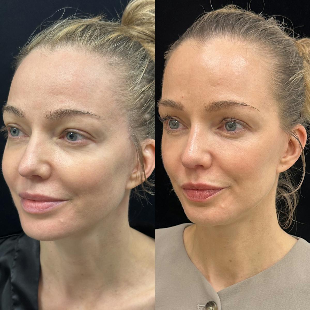 Lower Blepharoplasty Before & After Gallery - Patient 192923 - Image 3