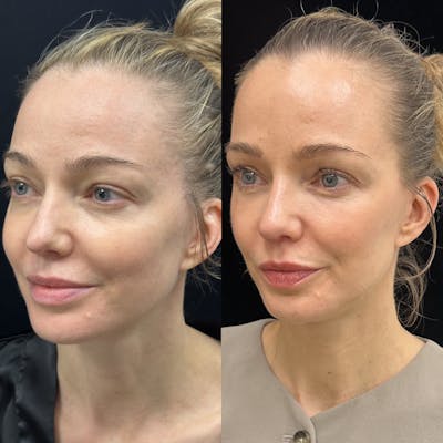 Lower Blepharoplasty Before & After Gallery - Patient 192923 - Image 3