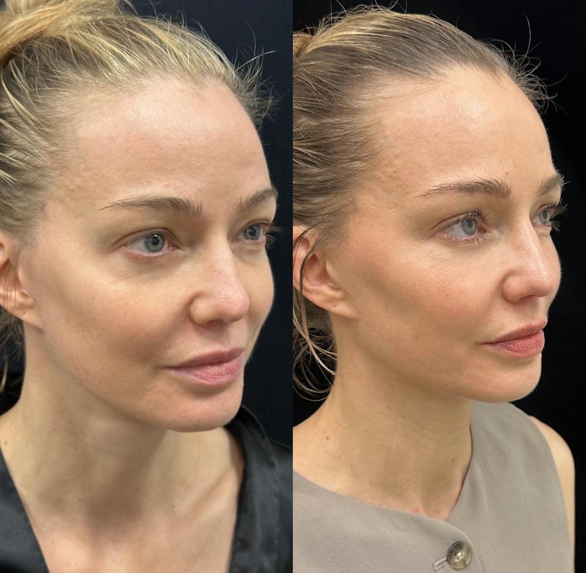 Lower Blepharoplasty Before & After Gallery - Patient 192923 - Image 2