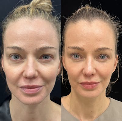 Lower Blepharoplasty Before & After Gallery - Patient 192923 - Image 1