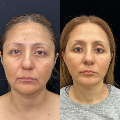Lower Blepharoplasty Before & After Gallery - Patient 209037 - Image 1