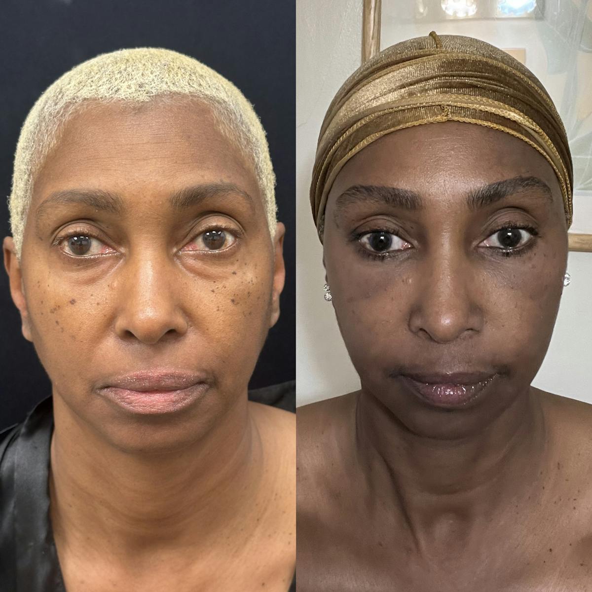 Lower Blepharoplasty Before & After Gallery - Patient 252054 - Image 1