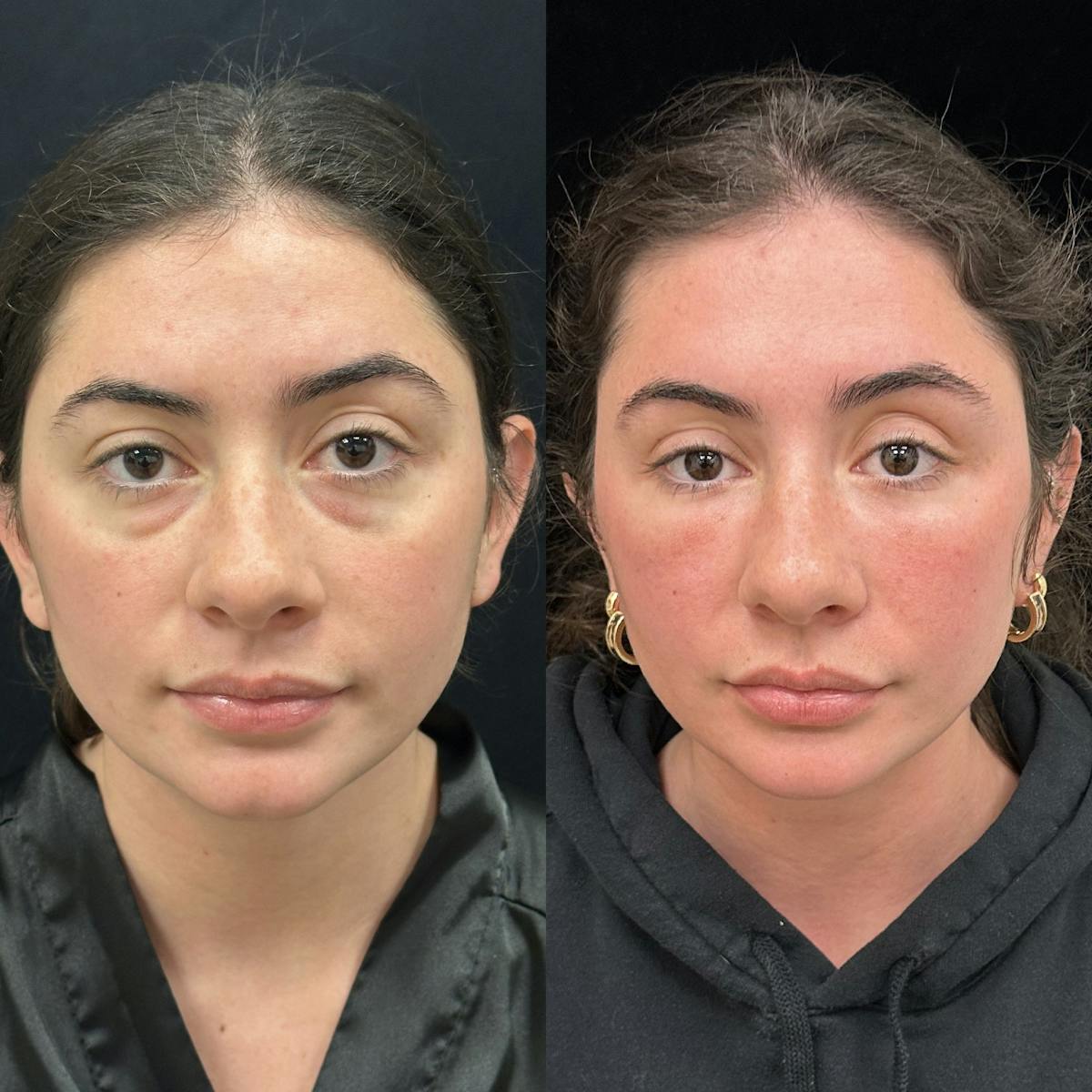 Lower Blepharoplasty Before & After Gallery - Patient 251613 - Image 1