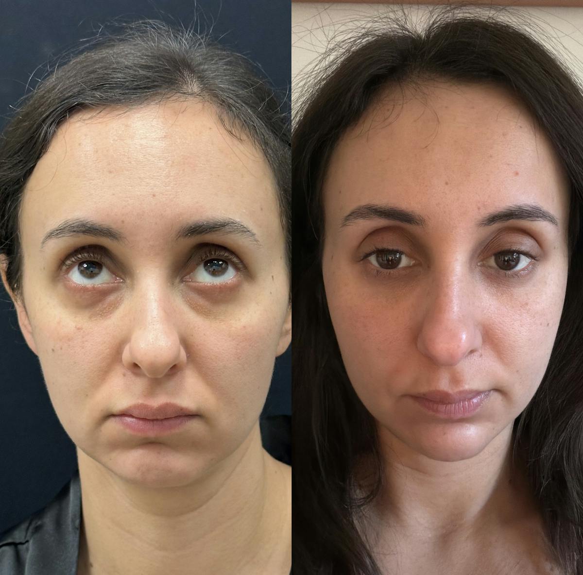 Lower Blepharoplasty Before & After Gallery - Patient 142183 - Image 2