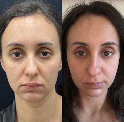 Lower Blepharoplasty Before & After Gallery - Patient 142183 - Image 1