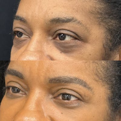 Lower Blepharoplasty Before & After Gallery - Patient 388099 - Image 3