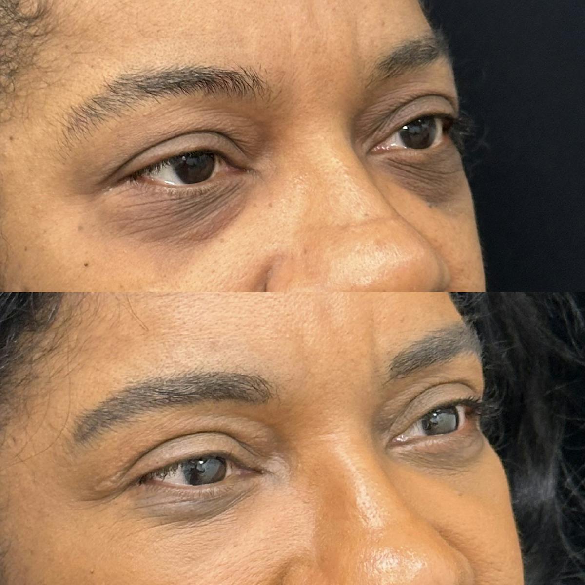 Lower Blepharoplasty Before & After Gallery - Patient 388099 - Image 2