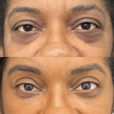 Lower Blepharoplasty Before & After Gallery - Patient 388099 - Image 1