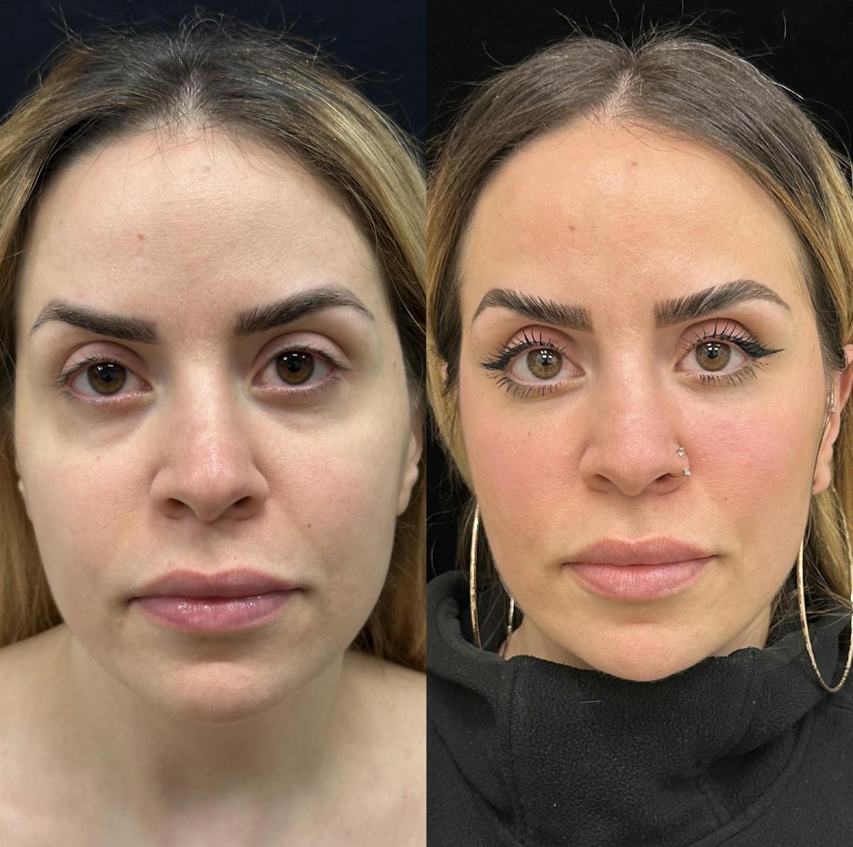 Lower Blepharoplasty Before & After Gallery - Patient 201767 - Image 1