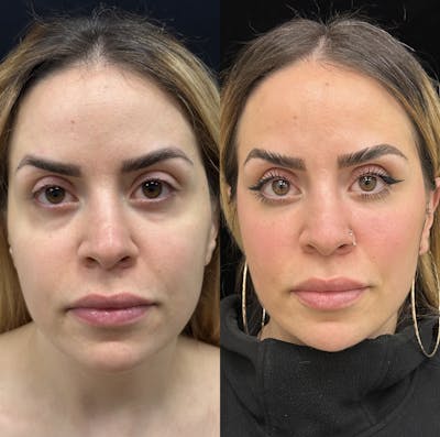 Lower Blepharoplasty Before & After Gallery - Patient 201767 - Image 1