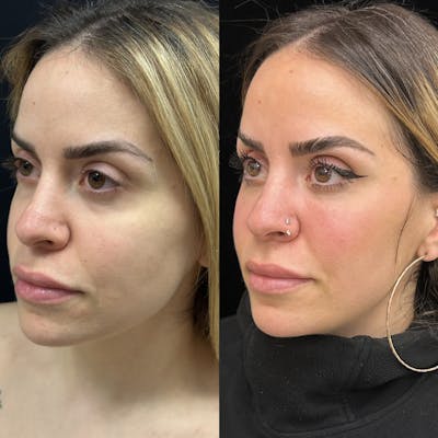 Lower Blepharoplasty Before & After Gallery - Patient 201767 - Image 4