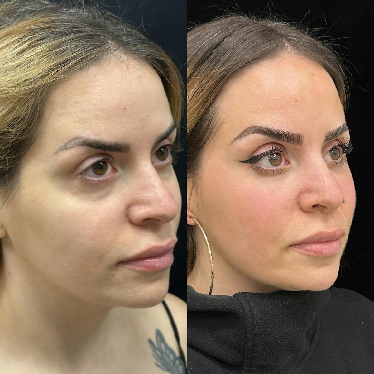 Lower Blepharoplasty Before & After Gallery - Patient 201767 - Image 3