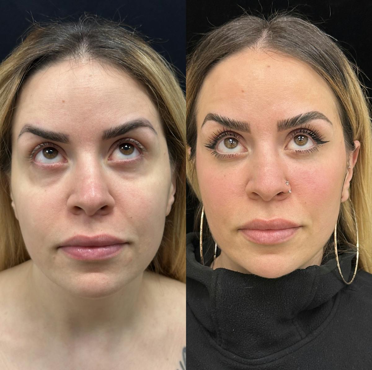 Lower Blepharoplasty Before & After Gallery - Patient 201767 - Image 2