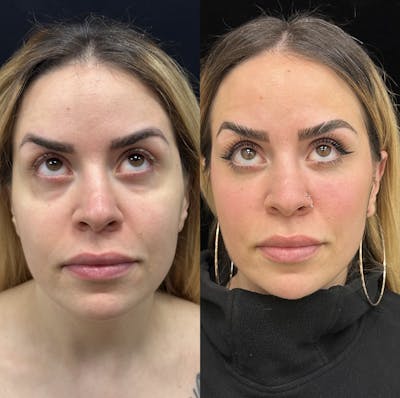 Lower Blepharoplasty Before & After Gallery - Patient 201767 - Image 2