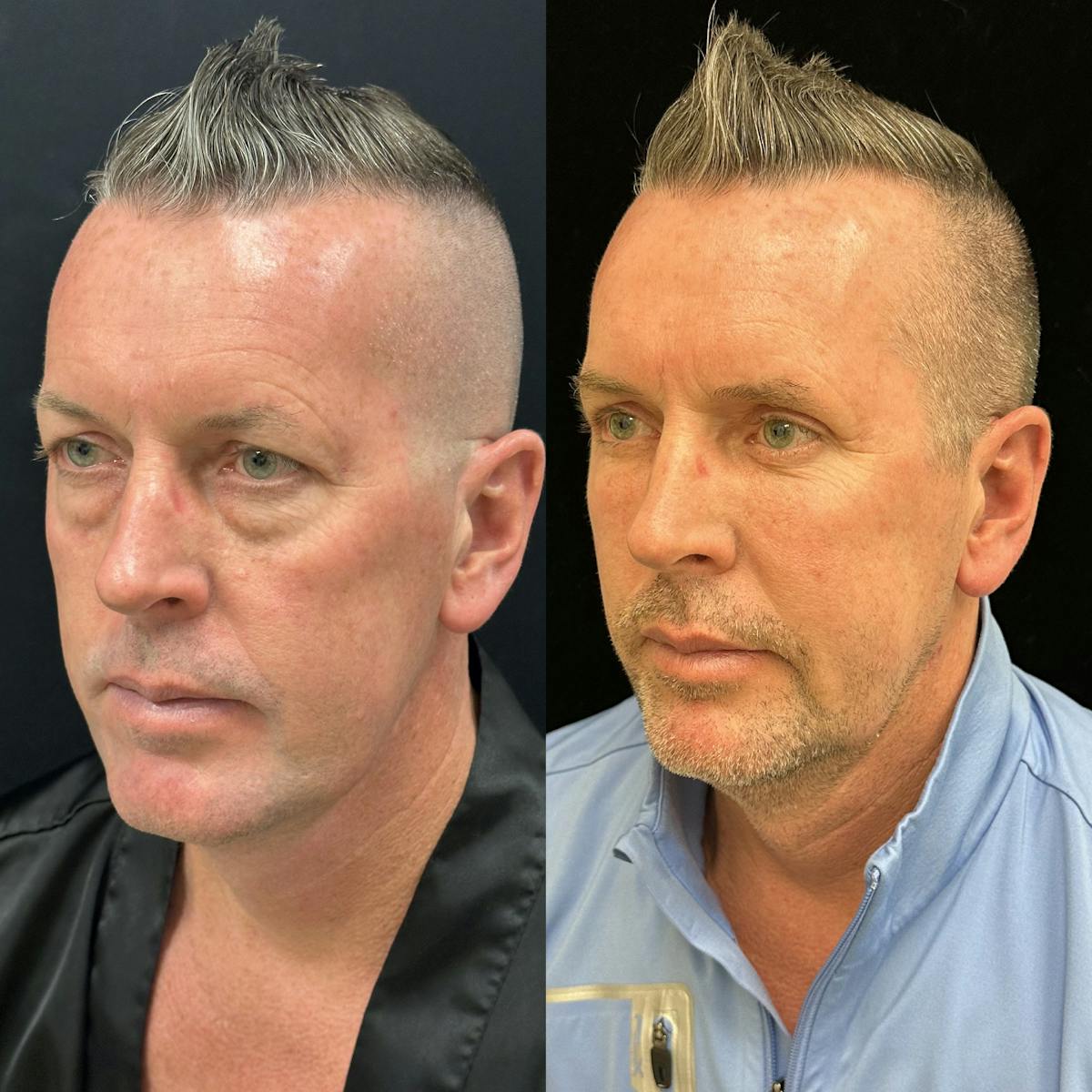 Lower Blepharoplasty Before & After Gallery - Patient 165563 - Image 2