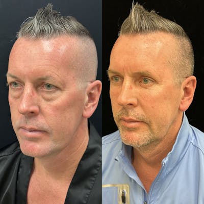 Lower Blepharoplasty Before & After Gallery - Patient 165563 - Image 2