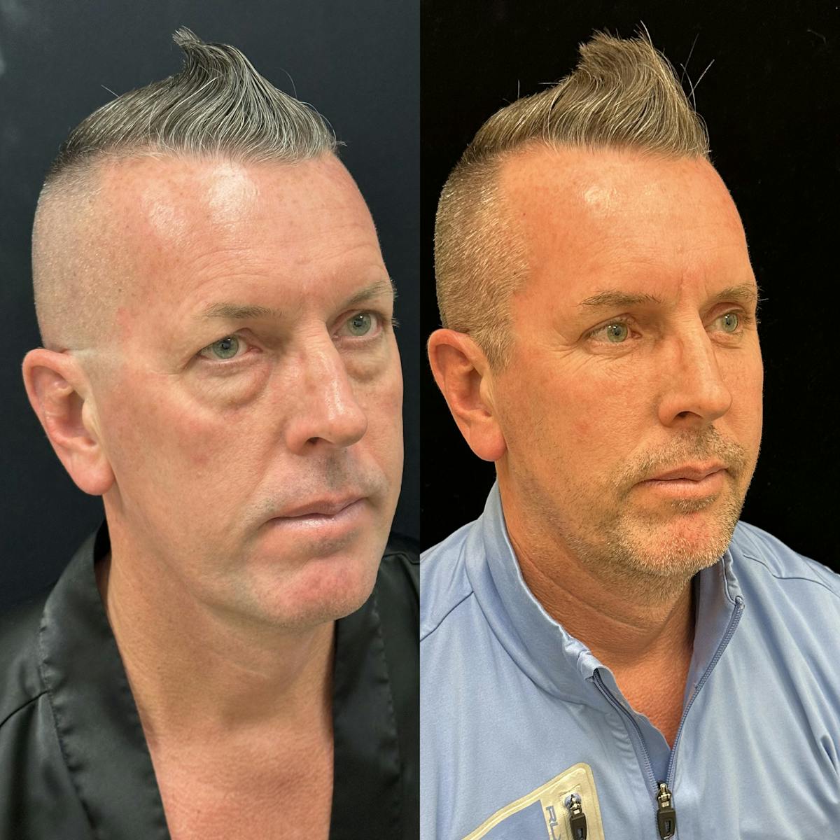 Lower Blepharoplasty Before & After Gallery - Patient 165563 - Image 3