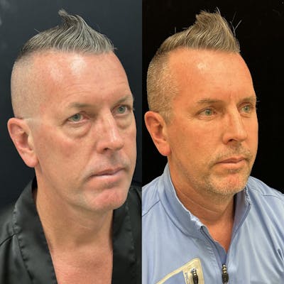 Lower Blepharoplasty Before & After Gallery - Patient 165563 - Image 3