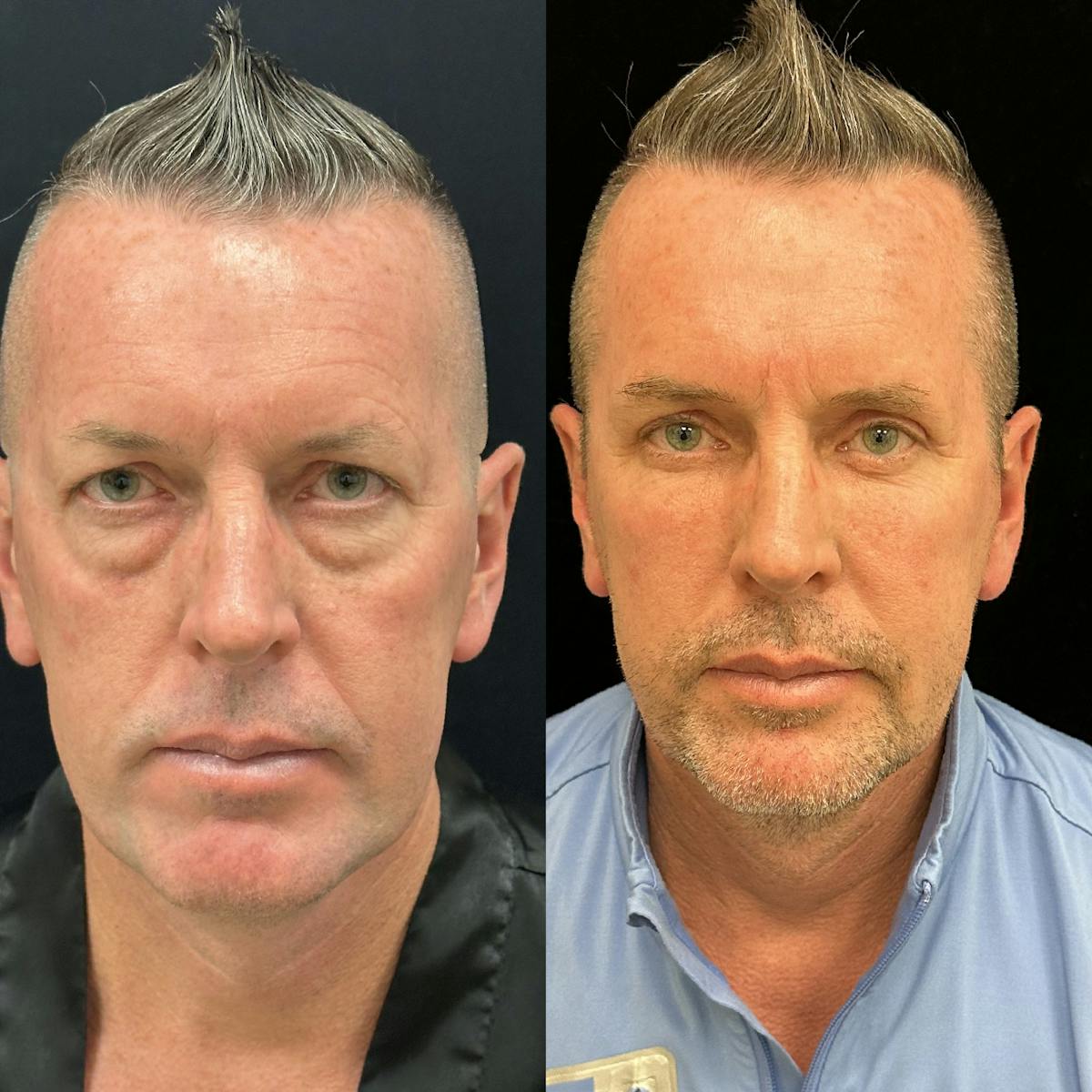 Lower Blepharoplasty Before & After Gallery - Patient 165563 - Image 1