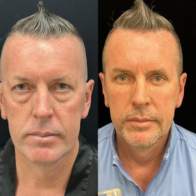 Lower Blepharoplasty Before & After Gallery - Patient 165563 - Image 1