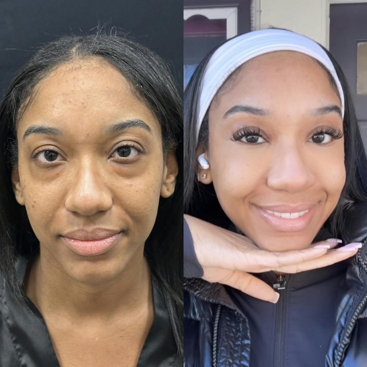 Lower Blepharoplasty Before & After Gallery - Patient 286744 - Image 1