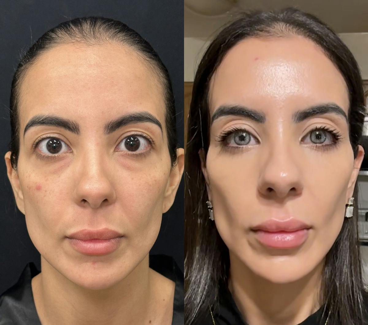 Lower Blepharoplasty Before & After Gallery - Patient 869276 - Image 1