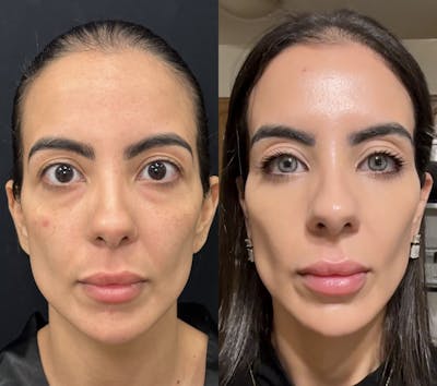 Lower Blepharoplasty Before & After Gallery - Patient 869276 - Image 1