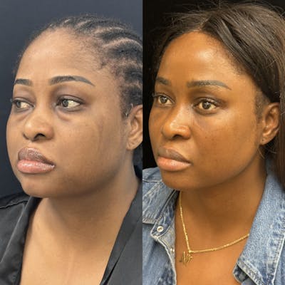 Lower Blepharoplasty Before & After Gallery - Patient 371614 - Image 2