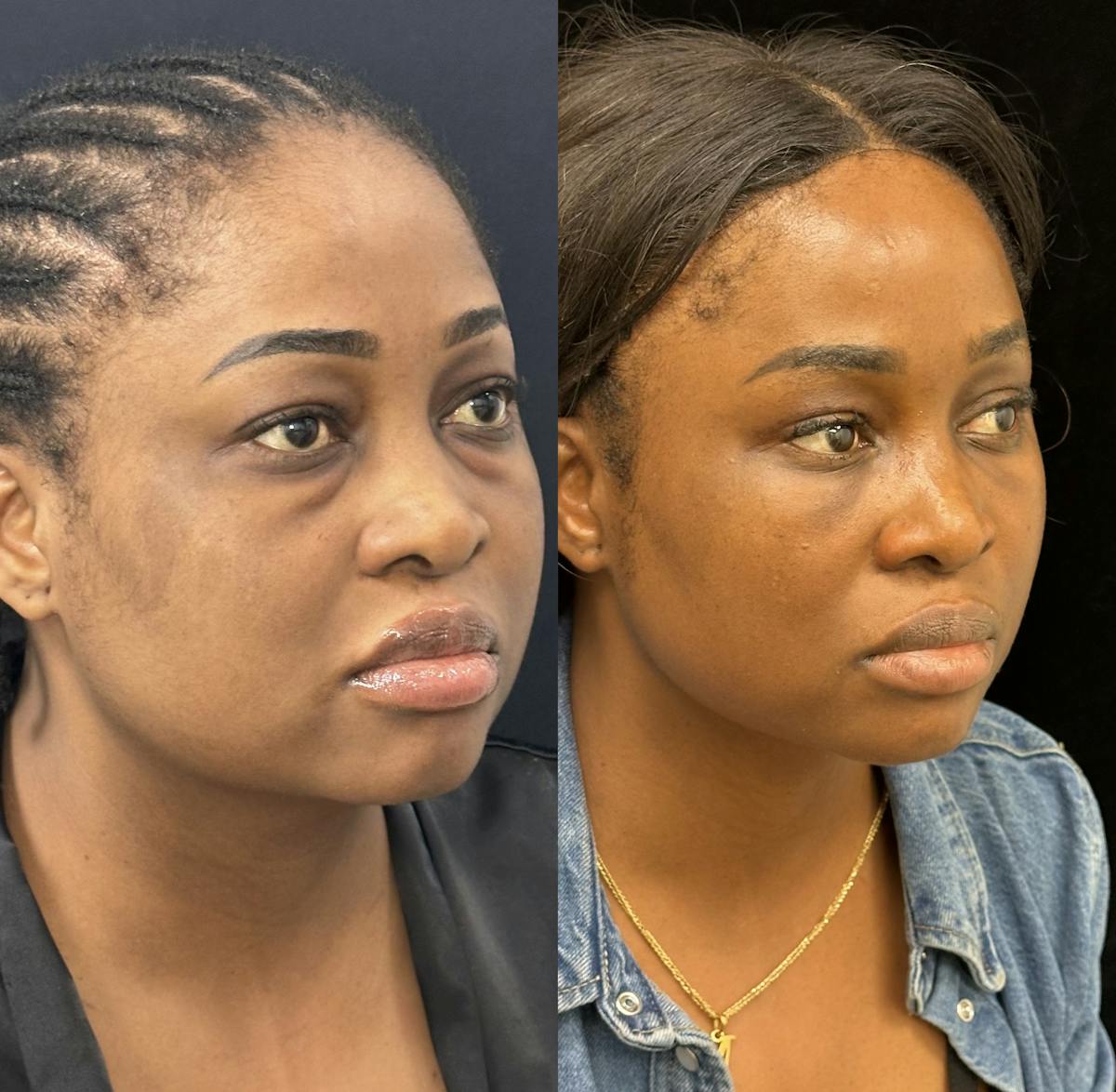 Lower Blepharoplasty Before & After Gallery - Patient 371614 - Image 3