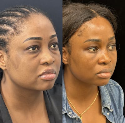 Lower Blepharoplasty Before & After Gallery - Patient 371614 - Image 3