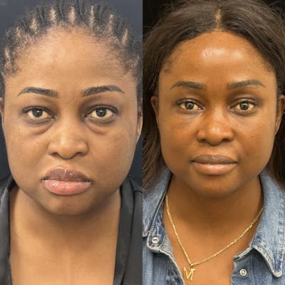 Lower Blepharoplasty Before & After Gallery - Patient 371614 - Image 1
