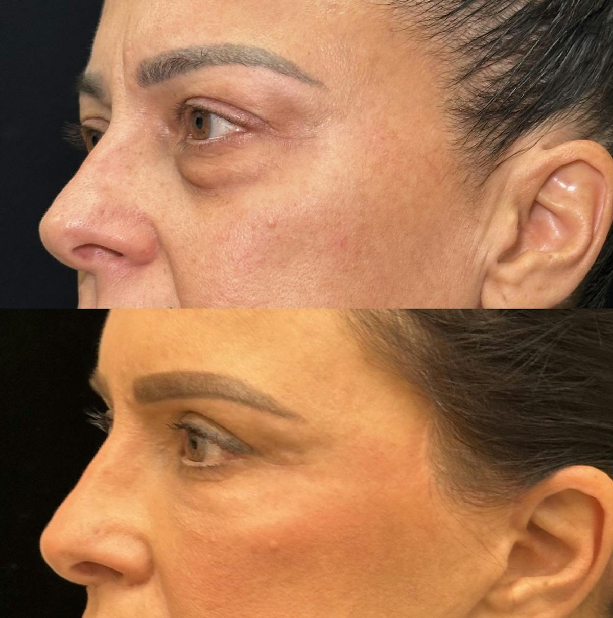 Lower Blepharoplasty Before & After Gallery - Patient 347573 - Image 2