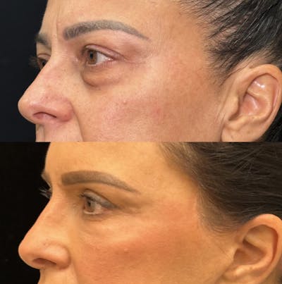 Lower Blepharoplasty Before & After Gallery - Patient 347573 - Image 2