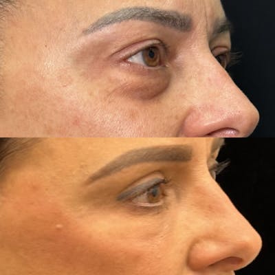Lower Blepharoplasty Before & After Gallery - Patient 347573 - Image 3