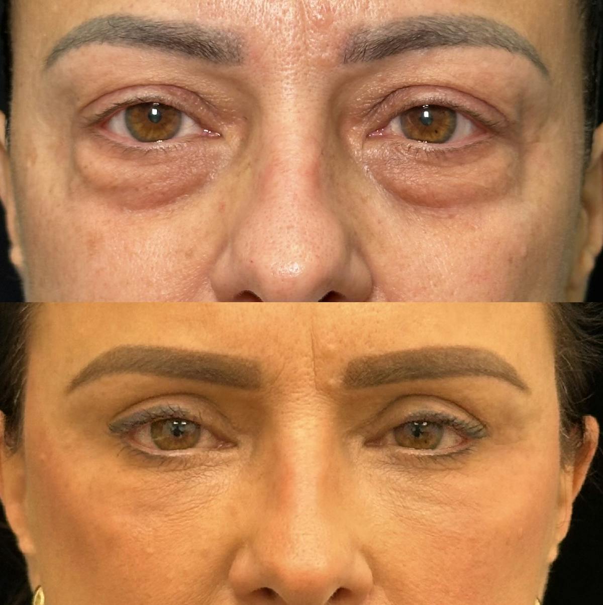 Lower Blepharoplasty Before & After Gallery - Patient 347573 - Image 1