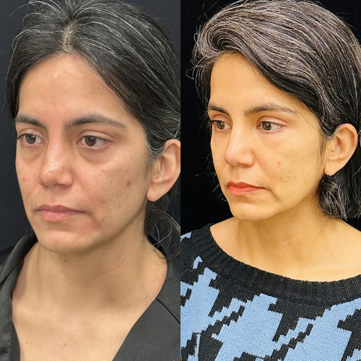 Lower Blepharoplasty Before & After Gallery - Patient 113483 - Image 2