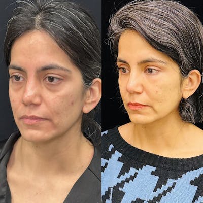 Lower Blepharoplasty Before & After Gallery - Patient 113483 - Image 2