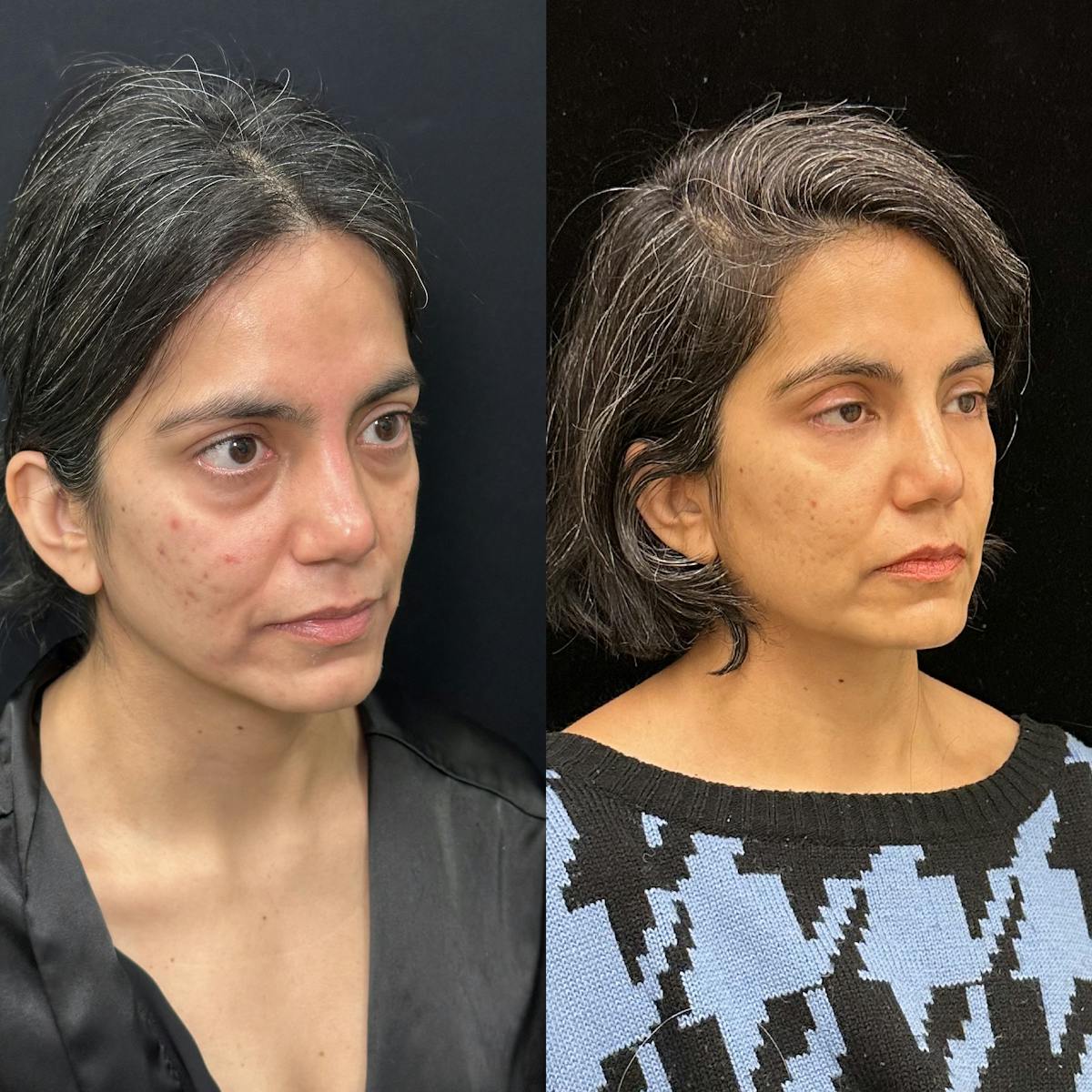 Lower Blepharoplasty Before & After Gallery - Patient 113483 - Image 3