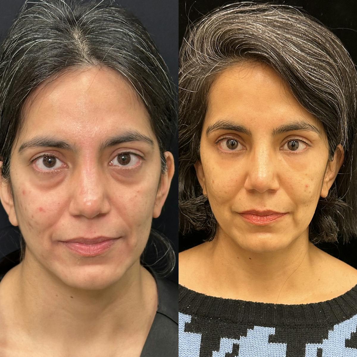 Lower Blepharoplasty Before & After Gallery - Patient 113483 - Image 1