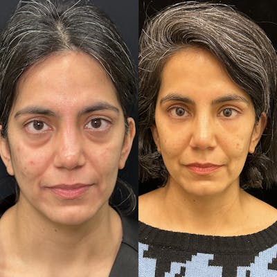 Lower Blepharoplasty Before & After Gallery - Patient 113483 - Image 1