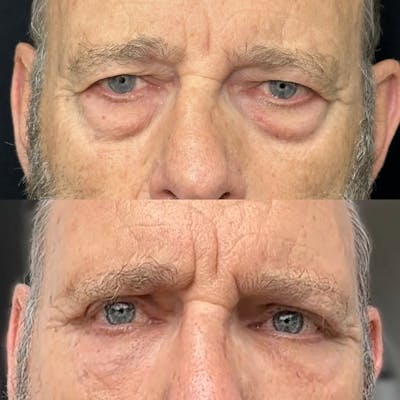 Lower Blepharoplasty Before & After Gallery - Patient 891421 - Image 1