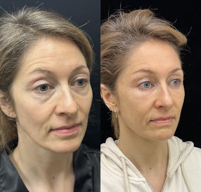 Lower Blepharoplasty Before & After Gallery - Patient 149032 - Image 4