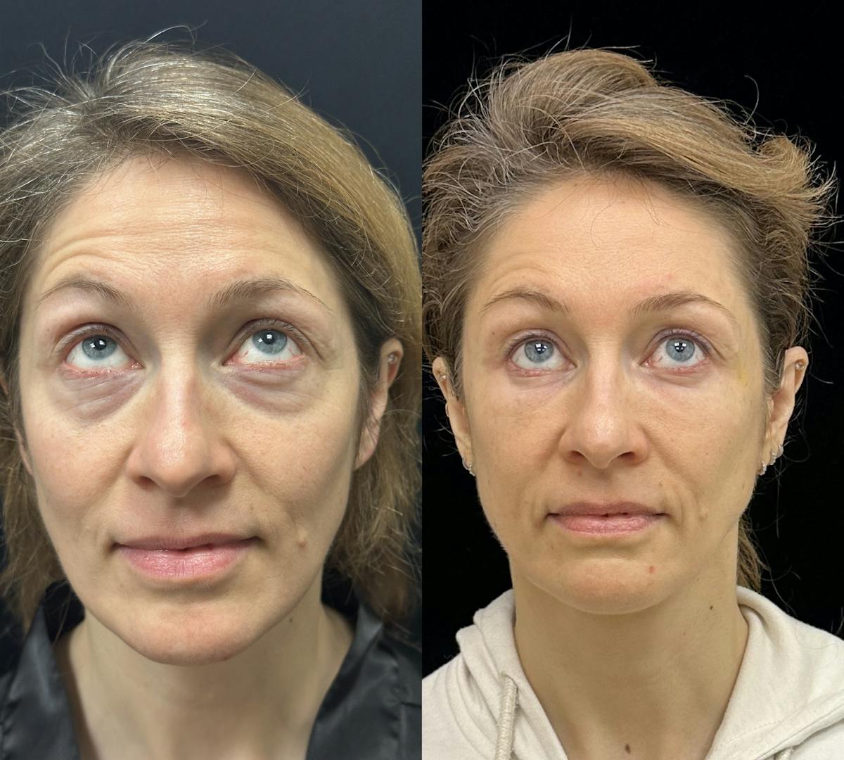 Lower Blepharoplasty Before & After Gallery - Patient 149032 - Image 2